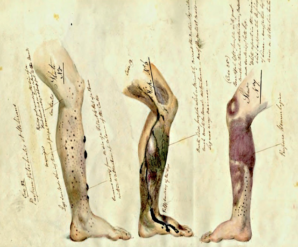 Watercolour illustrating the symptoms of scurvy, by marine surgeon Henry W. Mahon. The National Archives (UK) - 1841.